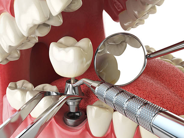 Best Emergency Wisdom Teeth Removal in West Perrine, FL